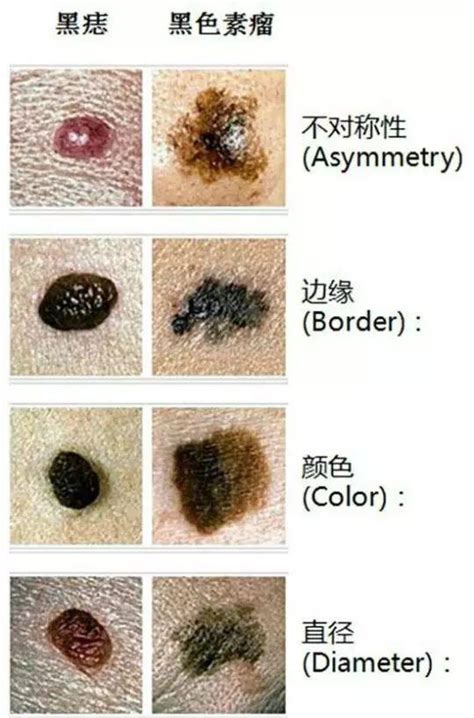 臉部痣|是痣還是瘤？黑色素瘤的類型、症狀與治療